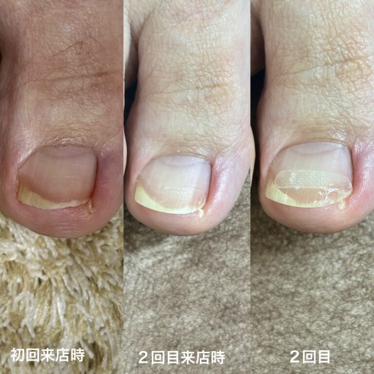 右親指